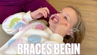 GETTING STARTED WITH BRACES AT AGE 8  SHORTEN BRACES TIME  MOUTH EXPANDER  TOO YOUNG FOR BRACES [upl. by Sikata]