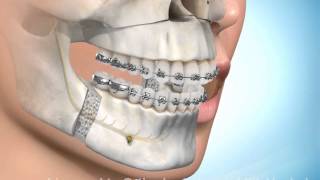 Chirurgische kaakcorrectie onder en bovenkaak [upl. by Den502]