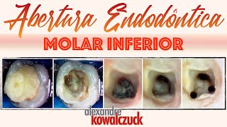 Abertura Endodôntica  Molar Inferior [upl. by Olegnaid]