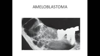 Maxillofacial radiology  MULTILOCULAR RADIOLUCENCY OF JAW [upl. by Ahsinyar]