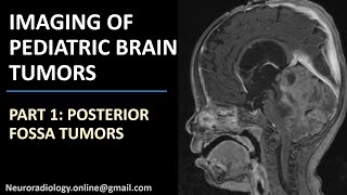 Imaging of Pediatric Brain Tumors part 1 Posterior fossa tumors [upl. by Eilerua]