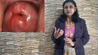 Nabothian cyst सर्विक्स बच्चेदानी के मुंह पर घाव का इलाजक्या सफेद पानी [upl. by Wieren536]