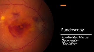 AgeRelated Macular Degeneration Exudative Fundoscopy [upl. by Nwadahs418]