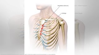 What You Need to Know About Tietze Syndrome  Tita TV [upl. by Awra]