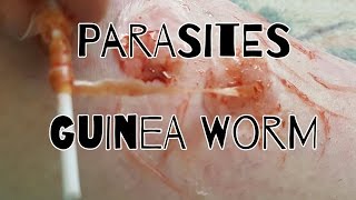 Guinea Worm  Parasites [upl. by Philbert188]