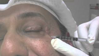 Blepharospasm and Botox Treatment [upl. by Yance69]