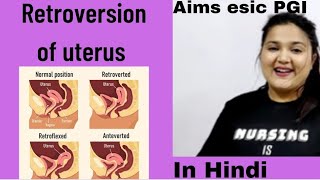 Retroversion of uterus Degrees of retroversion For medical students in Hindi [upl. by Nnybor]