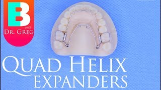 Quad Helix Expander for Braces  Invisalign [upl. by Raina]