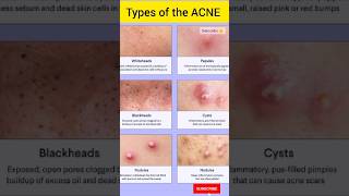 WHAT are the TYPES of the ACNE amp its TREATMENTshortsdermatologytypesofacnepimplesremedyfood [upl. by Atiuqcir]