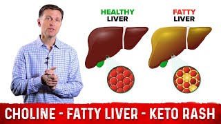 Choline One of The Best Vitamins for Fatty Liver – Dr Berg [upl. by Connett185]