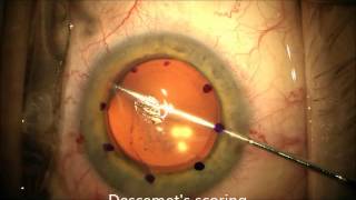 Descemets Stripping Automated Endothelial Keratoplasty DSAEK [upl. by Gnil30]