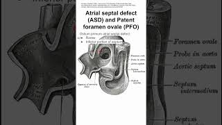 Atrial septal defect ASD and Patent foramen ovale PFO [upl. by Carn]