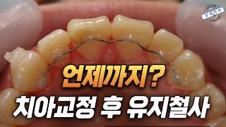 치아교정 끝난줄 알았는데 치아교정 후 붙힌 고정식 유지장치 유지철사 언제까지 하나 [upl. by Ibrek]