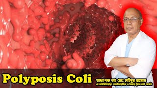 Polyposis Coli । কোলনে অসংখ্য পলিপ । অধ্যাপক ডাঃ মোঃ সহিদুর রহমান।LGSH [upl. by Edeline]