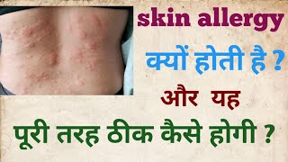 Allergy  urticaria पित्ती  क्यों होती हैं और इसका जड़ से इलाज कैसे होगा [upl. by Lerat]