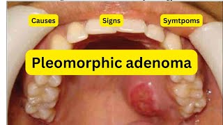 What is pleomorphic adenoma [upl. by Cook]