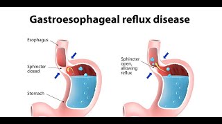 Gastroesophageal Reflux Disease GERD Treatmentعلاج الارتداد المعدي المريئي [upl. by Thayne978]