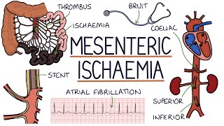 Understanding Mesenteric Ischaemia [upl. by Aloivaf994]