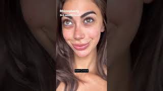 3 Month Rhinoplasty Update in Turkey OpDr Şükrü Turan [upl. by Marcellina]