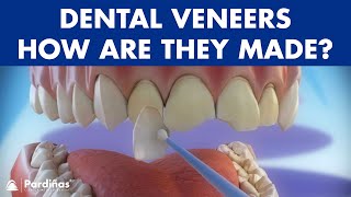 Veneers  How are they made Preparation and placement of cosmetic dentistry veneers © [upl. by Eibrab]