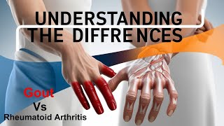 Gout Vs Rheumatoid Arthritis Understanding the Differences [upl. by Hoi]