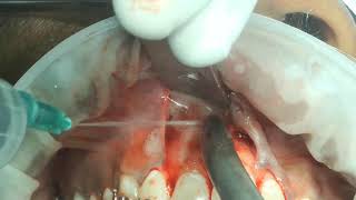 part 2 inverted and impacted  internal resobed mesiodens surgical removal [upl. by Eissed]