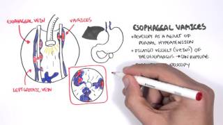 Upper GI Bleed Causes Overview [upl. by Noguchi]