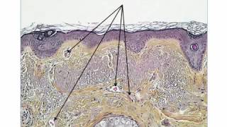 2 new dermoscopic criteria for LMM on the face by Dr Luc Thomas [upl. by Elbam]