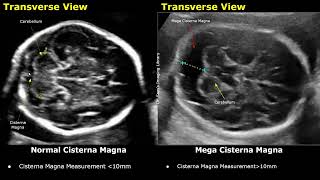 Edwards Syndrome Trisomy 18 Antenatal Ultrasound Features  Fetal USG Normal Vs Abnormal Images [upl. by Downey]