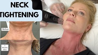 Morpheus8 Skin Tightening for Sagging Neck and Jowels  Before amp After Over 50 [upl. by Johns]