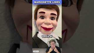 Marionette Lines Before and After Plastic Surgery Results [upl. by Nojel]