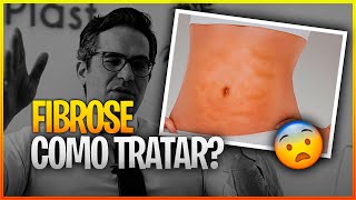 COMO TRATAR A FIBROSE APÓS LIPOASPIRAÇÃO 😨 [upl. by Nnasor]