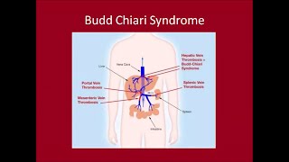 Management of Budd Chiari Syndrome [upl. by Inahs683]