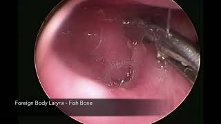 Difficult Foreign Body Throat  Fish Bone Right Pyriform Fossa [upl. by Hobard]