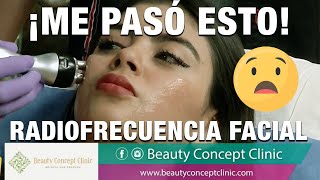 🥺😱 ME HICE RADIOFRECUENCIA facial luego de la Bichectomía ¡Y me pasó ESTO [upl. by Chatwin]