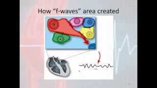 Basic Electrophysiology part 7  Atrial Rhythms part 3 Atrial Fibrillation and Atrial Flutter [upl. by Elocon]