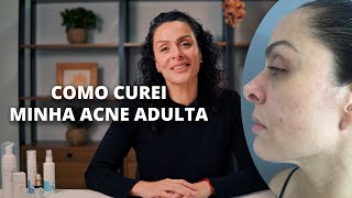 DICAS PARA ACNE ADULTA acneadulta pelemadura tratamentodapele [upl. by Nnagem254]