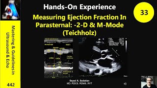 Measuring Ejection Fraction In Parasternal 2D amp MMode Teichholz [upl. by Phyl575]