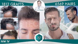 ITALIAN MAN  1812 Grafts  6569 hairs  Average of 363 hair  Grafts  DR RAFAEL DE FREITAS [upl. by Yecart]