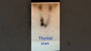 Thyroid scan nuclear medicine technologist pet thyroid nuclear gamma radiological radiography [upl. by Afihtan]