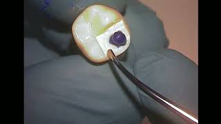 Teaching Dentistry Creating cusp anatomy with inlay wax [upl. by Arok667]