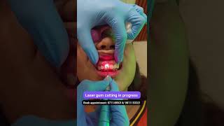 LIVE Laser Gum cutting Gummy smile treatment Dr Srishti Bhatia [upl. by Werdma]