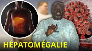 Hépatomégalie P01  Causes et consequences   Pr Ousmane Ndiaye  LANSARR TV [upl. by Ahsytal]