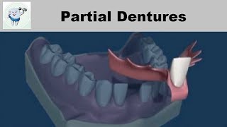 Removable Partial Dentures [upl. by Donni]