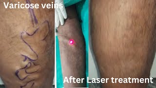 varicose veins treatment in Ranchi Laser treatment of varicose veins [upl. by Olodort]