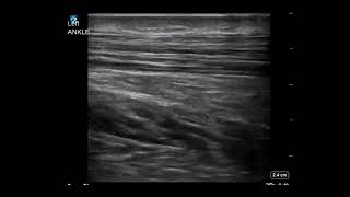 Ankle Ultrasound Achilles Tendonitis With Enthesophyte [upl. by Marco]