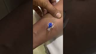 IV cannula insertiondoctertrendingforyoushortvideoviralvideo [upl. by Alleira723]