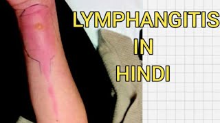 Acuteamp chronic lymphagitis in hindi  Cause  symptom [upl. by Westberg]