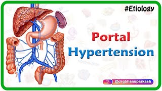 Portal hypertension USMLE Step 1  Etiology Clinical features Diagnosis and Treatment [upl. by Sliwa]