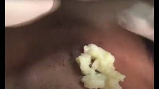 Crazy Satisfying cyst and Blackheads Remove 2024 [upl. by Goff]